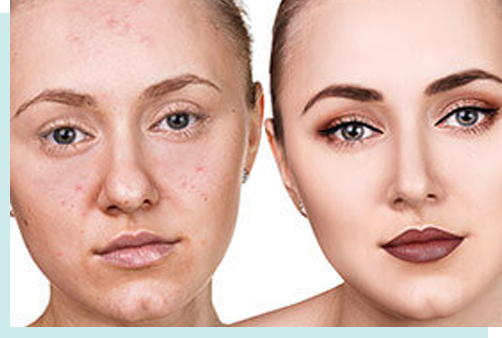 Before and After Acne Scars Treatment