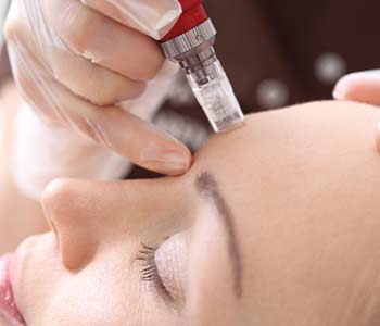 Microneedling Has A Plethora of Benefits for Your Skin