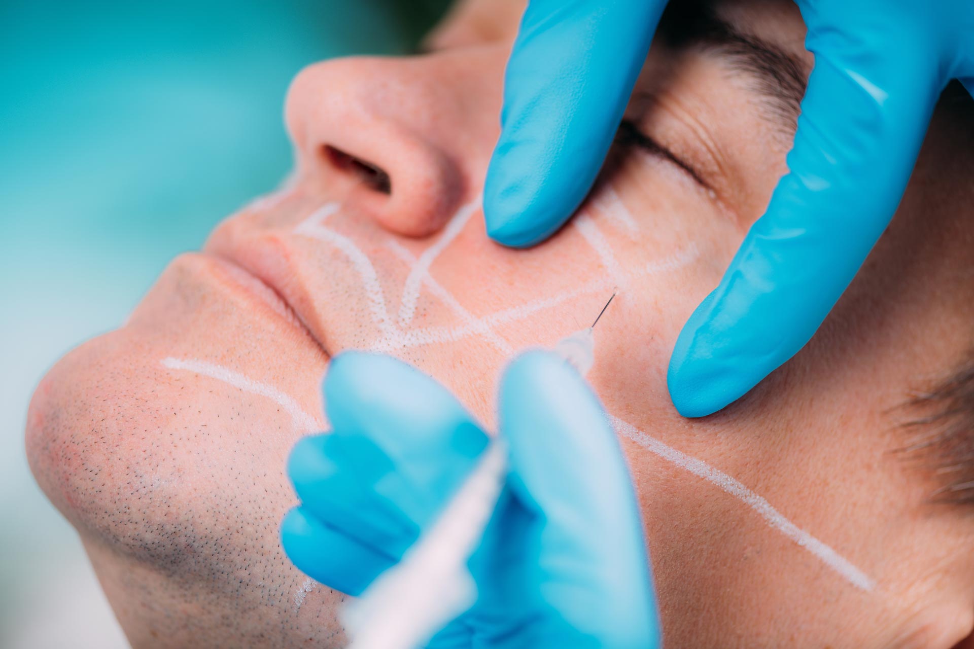 What are the Benefits of Dermal Fillers?
